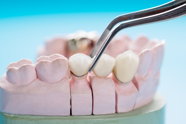 The Types Of Dental Bridges: What You Should Know